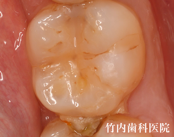 治療例09術前