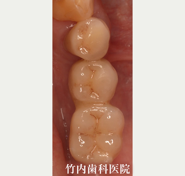治療例02術後