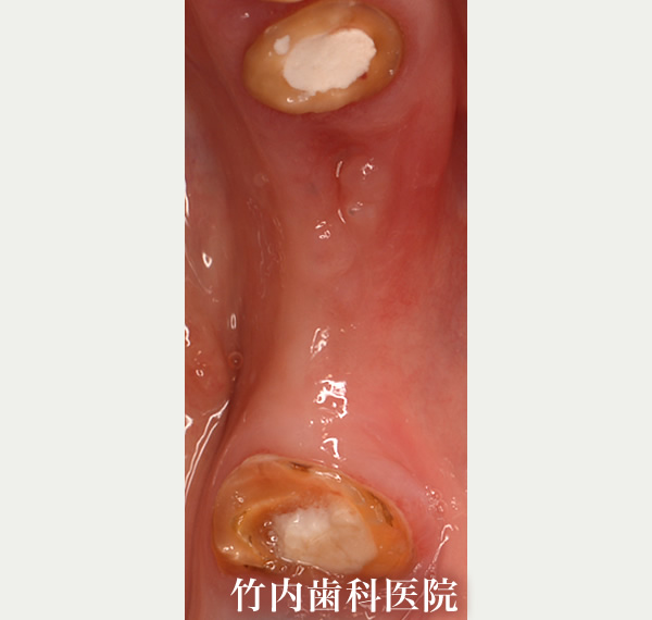 治療例02術前