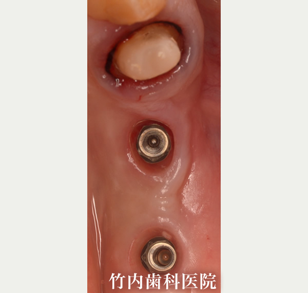 治療例02治療中