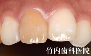 治療例01術前
