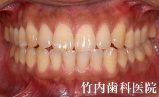 治療例03術前