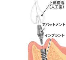 人工歯の作製・装着