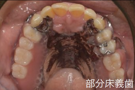 部分床義歯