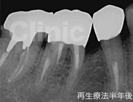 再生療法半年後