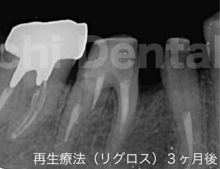 再生療法（リグロス）3ヶ月後